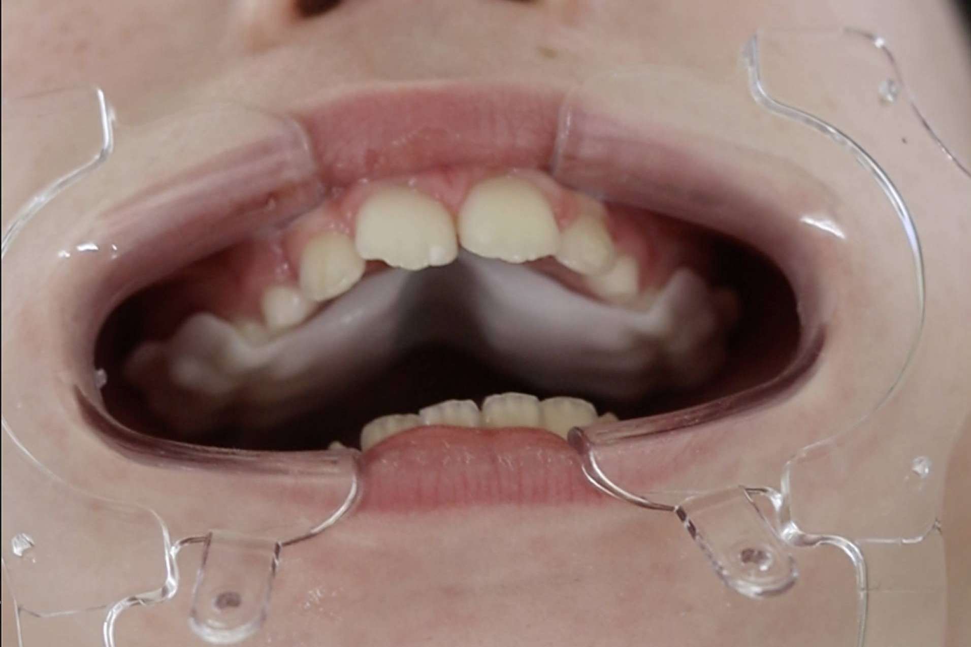 Smart Aligner Services welcomes the Palatal Expander at their 'Dental and Skeletal Expansion' event